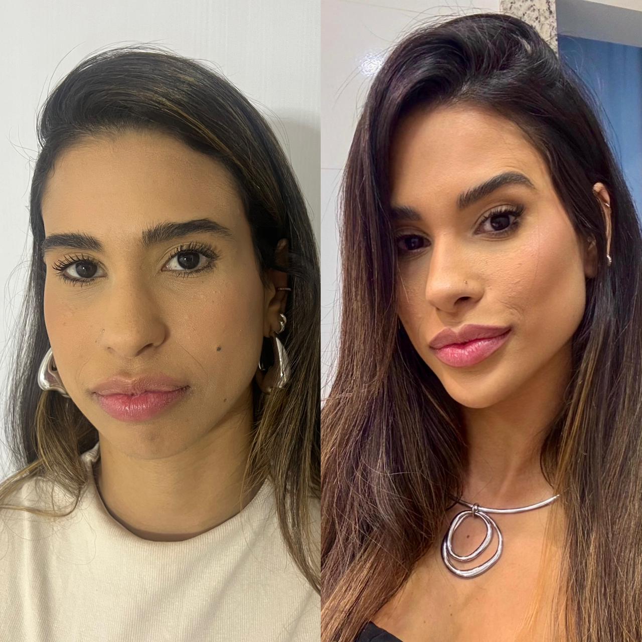 Antes e depois — Rejuvenescimento Facial